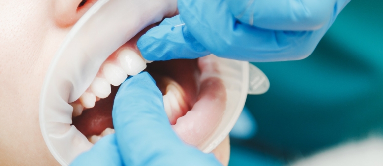 Warum man Zahnseide benutzen sollte? Ein Zahnarzt in Heidelberg erklärt weshalb.